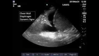 Lung and Pleural Ultrasound: Interpretation