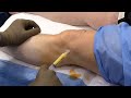 Liposuction: Adipose-derived Stem Cell Transplantation for Osteoarthritis
