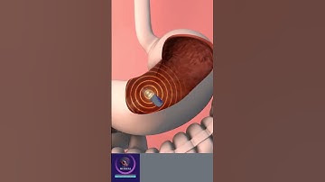 Stomach Endoscopy Procedure - 3D animation
