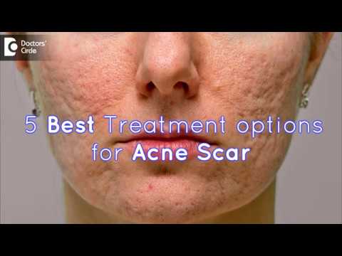 Video: Chemical Peel Untuk Acne Scars: Home Vs. Professional & More