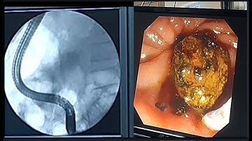 Ercp Balloon Sphincteroplasty & stone extraction -SQUARE HOSPITAL LTD Dhaka Bangladesh #BD_ENDOSCOPY