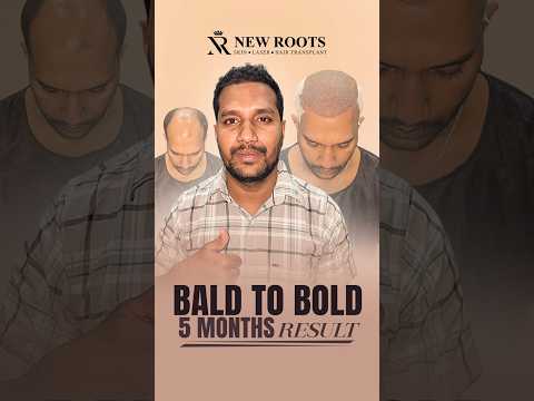 Hair Transplant in Raipur (Grade 6 Baldness) | Cost and Results #hairtransplant #shorts