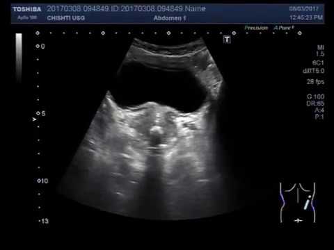 Ultrasound Video showing Enlarged Prostate with calcification & Stone
