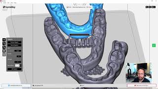 Printing nightguards with VuBase5 for minimal supports using a new support hack in Rayware