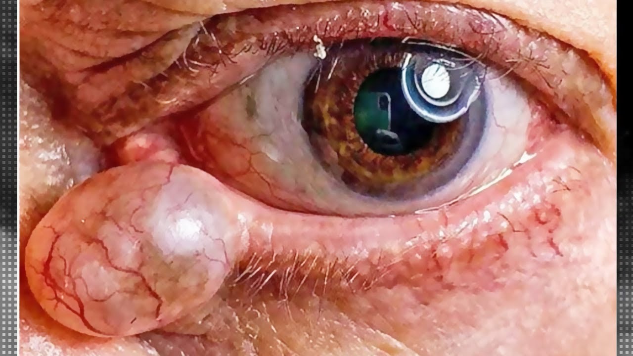 Hidrocystomas! What Are These Eye Cysts? YouTube