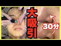 毛穴大吸引！！『ハイドラフェイシャル』を男が初体験【いちご鼻・角栓除去】(日本語字幕/한국어자막)