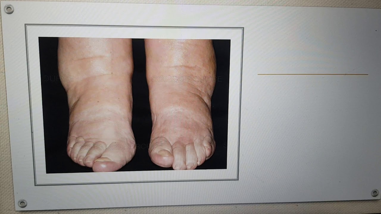 Leg Swelling possible causes explained in Amharic የእግር እብጠት ምክንያቶች