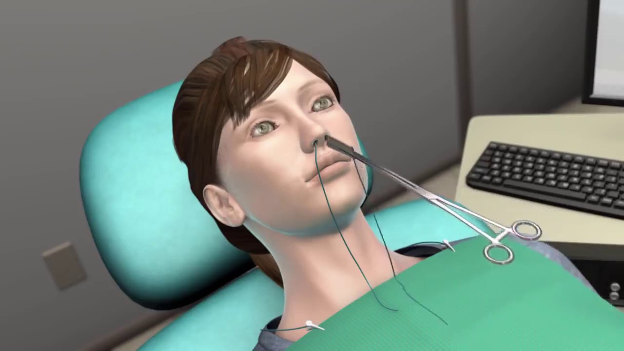 Mengenal Penyakit Sinusitis 