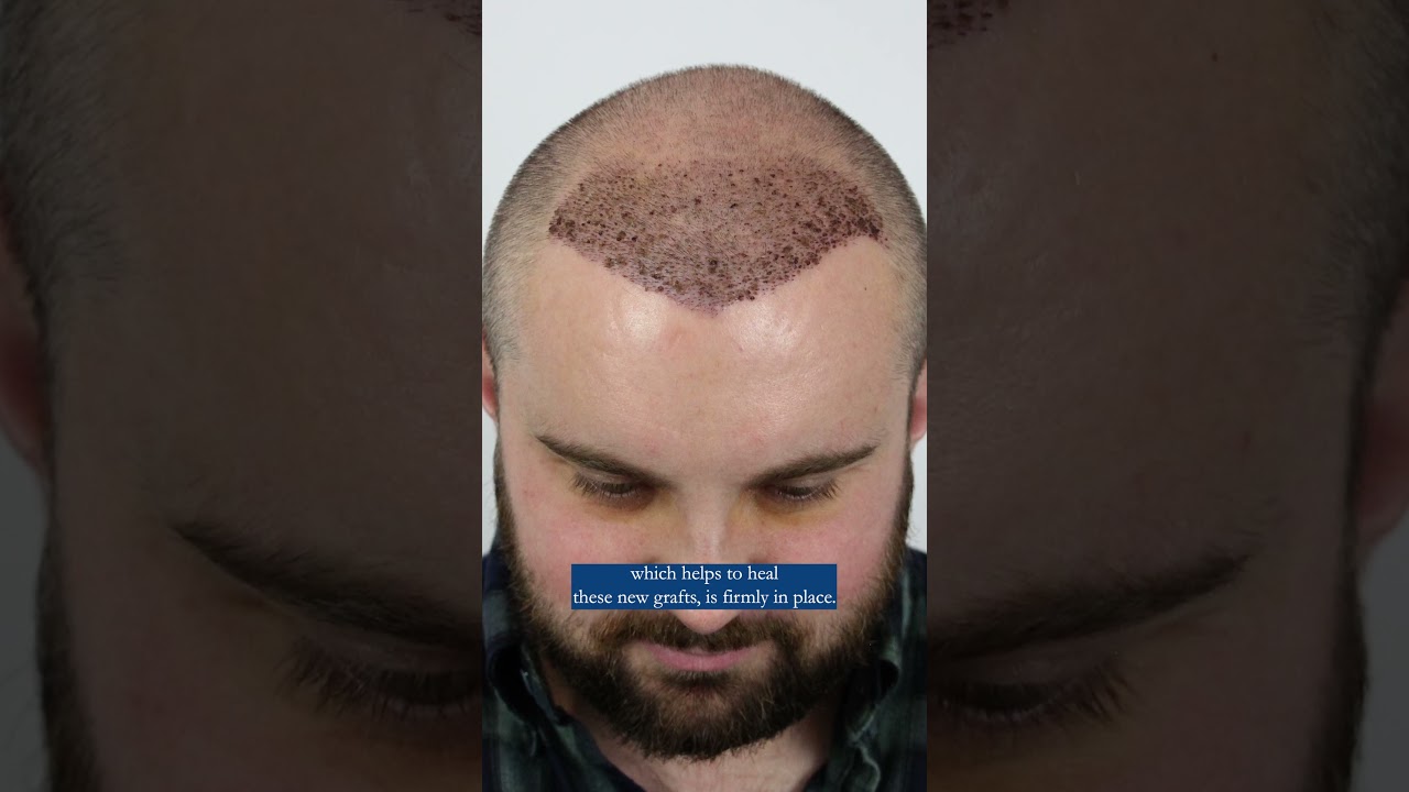 How Long After My Hair Transplant Can I Wear A Hat? - Part 2