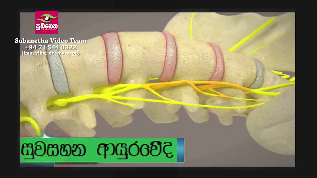 Ayurvedic Treatments for Back Pain, Spinal cord compression Dr Amila Bandara YouTube