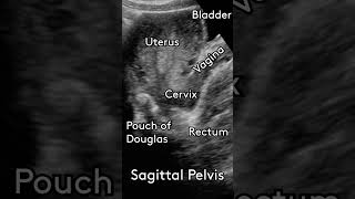 Basic Pelvic Anatomy for 1st Trimester Ultrasound  #ultrasound #pocus