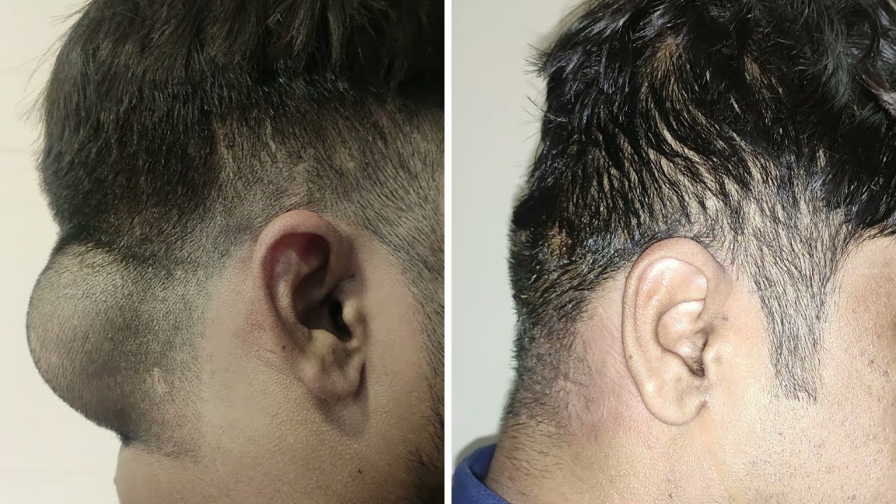 SCALP MASS/ LIPOMA REMOVAL SCARLESS SURGERY ; Dr VICKY JAIN PLASTIC