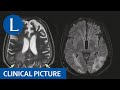 Neuropathy, encephalopathy, status epilepticus, and acute intermittent porphyria