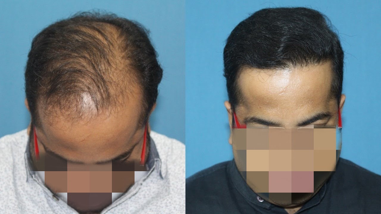 Hair Transplant clinic in Gurgaon at Eugenix - YouTube