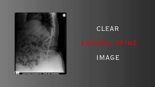 Live Demo: TEMSIS miniX Handheld X-Ray | Clear Lateral Spine Imaging