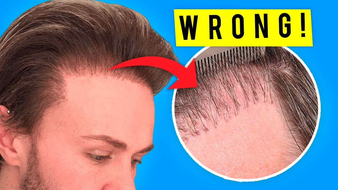 7 Reasons Why Hair Transplants Fail