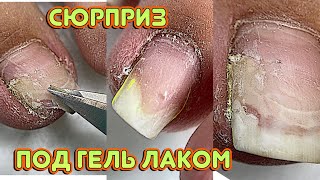 Сюрприз под гель лаком  😕 Отошел ноготь / Педикюр