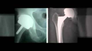 Zimmer Hip Recall Legal Advise