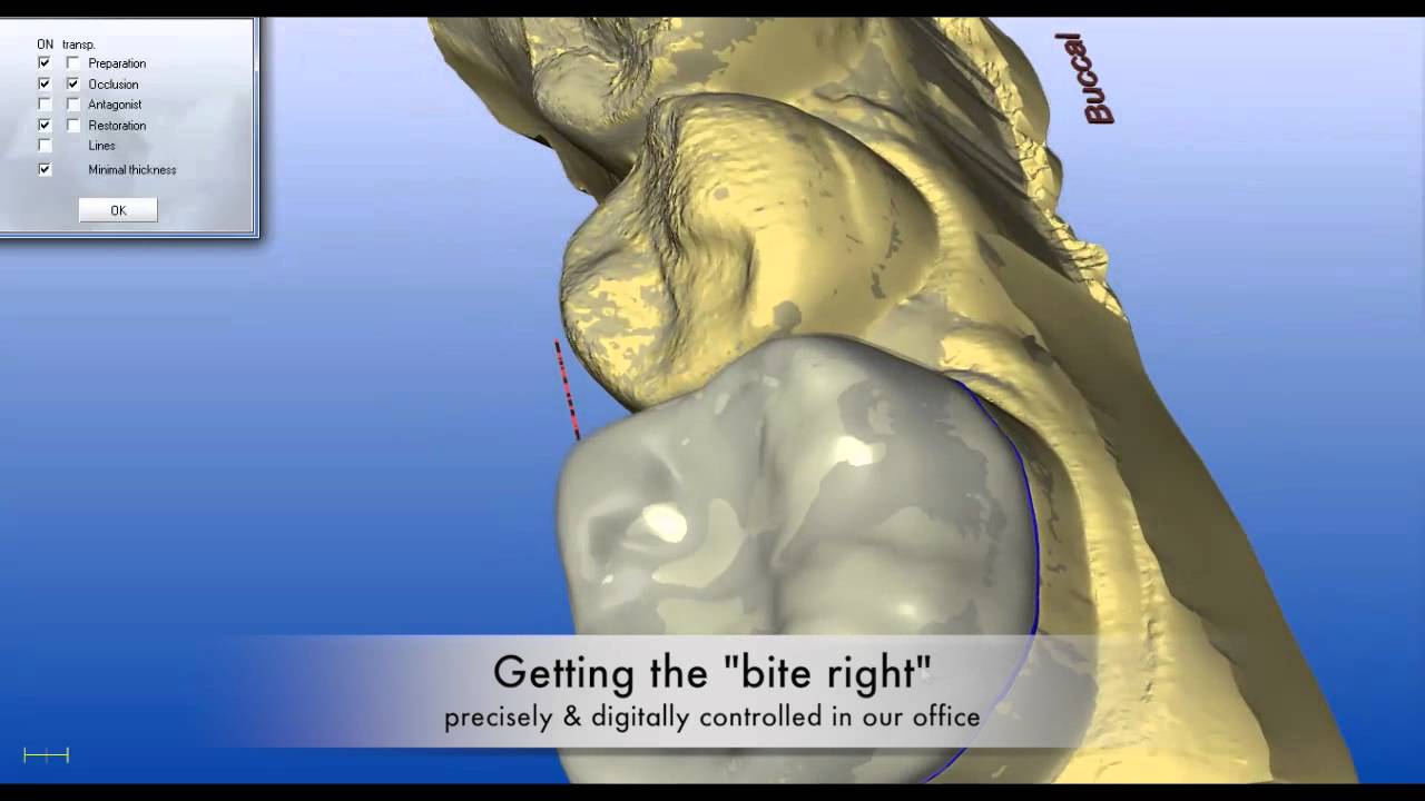 Same day CEREC porcelain crowns in Northwest Arkansas