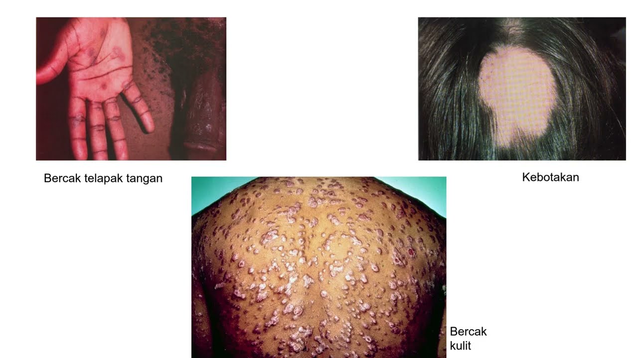 Materi Infeksi Menular Seksual - Dr  Dian Ardiana, dr , SpDVE, FINSDV, FAADV