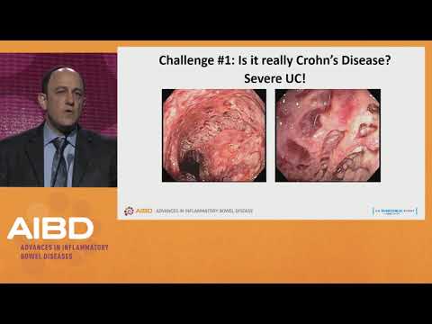 Challenges in the treatment of severe Crohn&rsquo;s disease