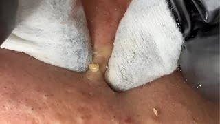 Blackhead Removal: Satisfying Routine | 138