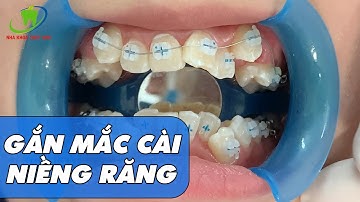 Quá trình gắn mắc cài niềng răng diễn ra thế nào