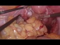 Fimbrial expression in unruptured tubal gestation dr  renu gahlaut