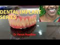 Dental Implant Series | Dental Implant Complete Procedure | Dr Varun Nambiar | 04985 204525