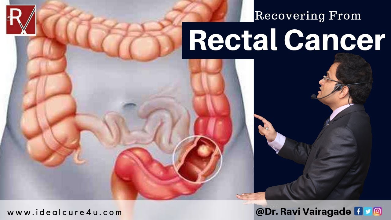 Rectal cancer (Cured Case)cancercancertreatment