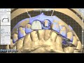 3shape design  anterior teeth