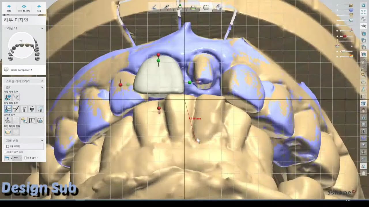 3shape design  (anterior teeth)