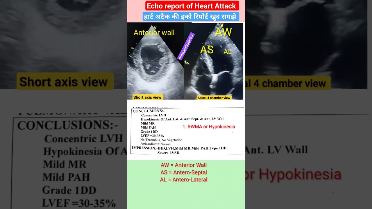 Echo report of heart attack l हार्ट अटैक का एको रिपोर्ट खुद देखे 