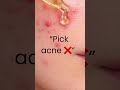 Stop Picking Acne ❌
