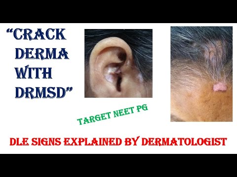 Discoid Lupus Erythematosus Clinical Carpet Tack Sign Dle Rash Pictures Shusters Drmsd You