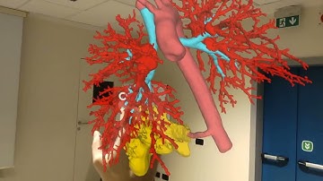 Preoperative Holographic Assessment of Pulmonary Anatomy for Intralobar Sequestration