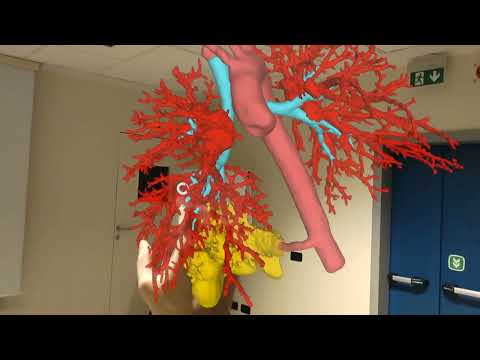 Preoperative Holographic Assessment of Pulmonary Anatomy for Intralobar Sequestration