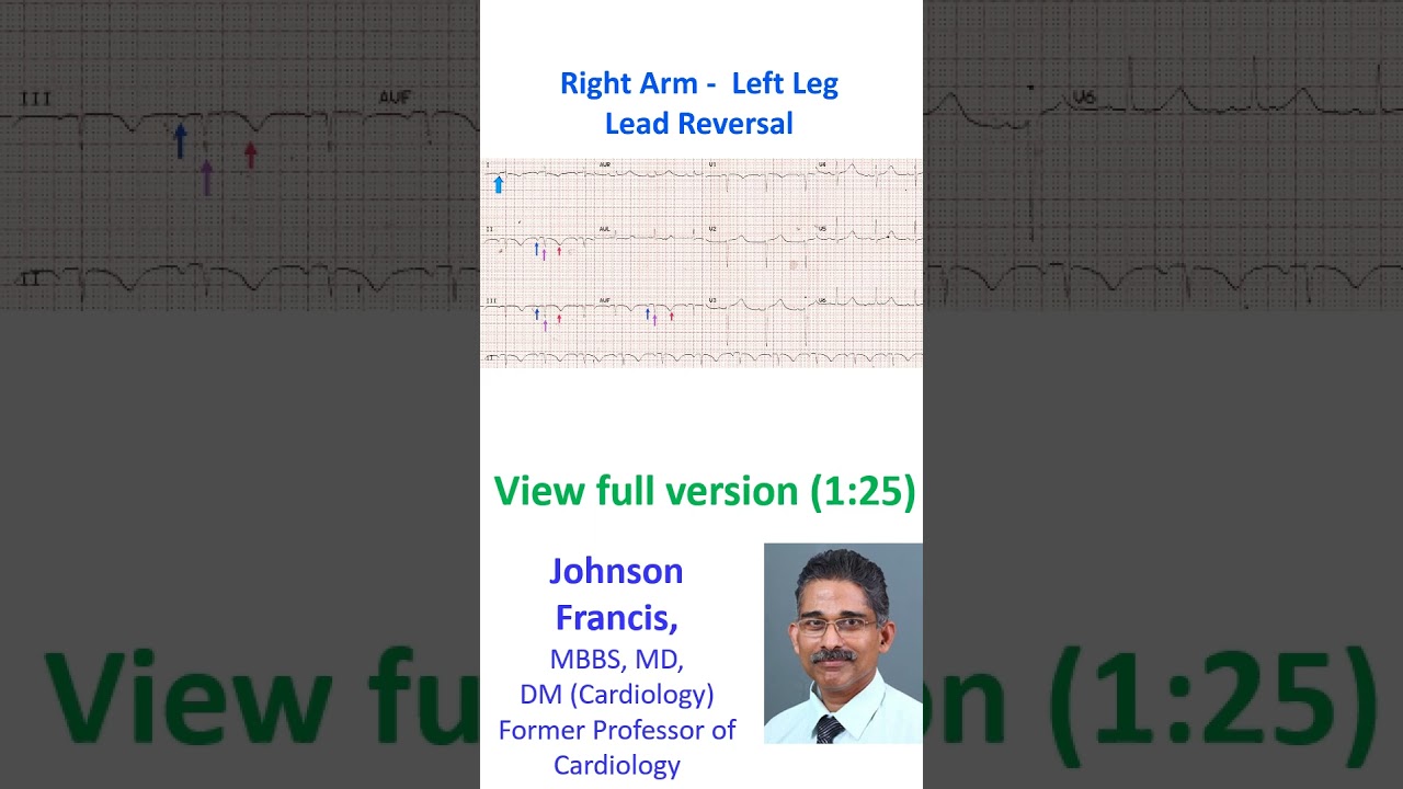Right Arm -  Left Leg Lead Reversal