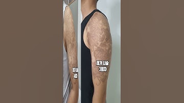 대형문신제거 변화과정 부천더피부과 #shorts