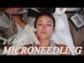 I tried MICRONEEDLING: daily vlog ft. Chef Steph