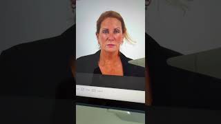 3 months after Deep Plane Facelift, Neck lift and laser resurfacing