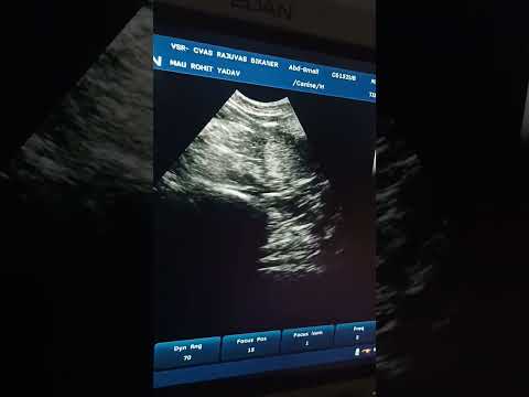 Enlarged prostate gland