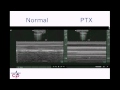 Critical Points: beside ultrasound for pneumothorax