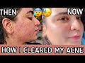HOW I CLEARED MY SKIN | PCOS *CYSTIC*ACNE |