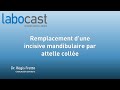 Remplacement dune incisive mandibulaire par une attelle colle