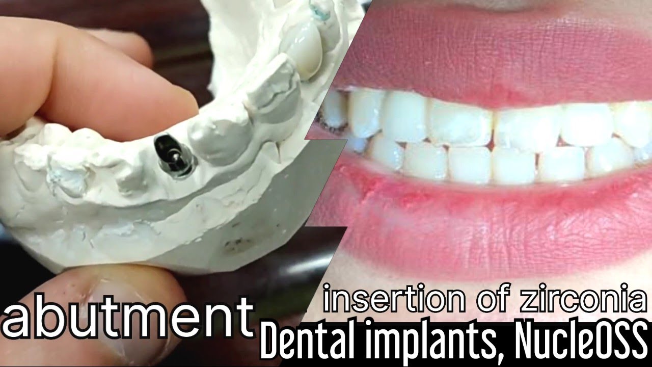 Зубные имплантаты, NucleOSS