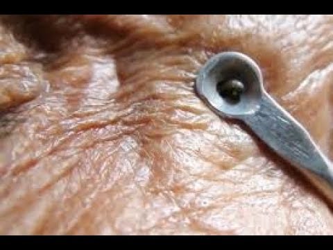 Blackheads Extracting Acne ,Face Pimples, Cystic Acne  And Treatment For Relaxing Part 