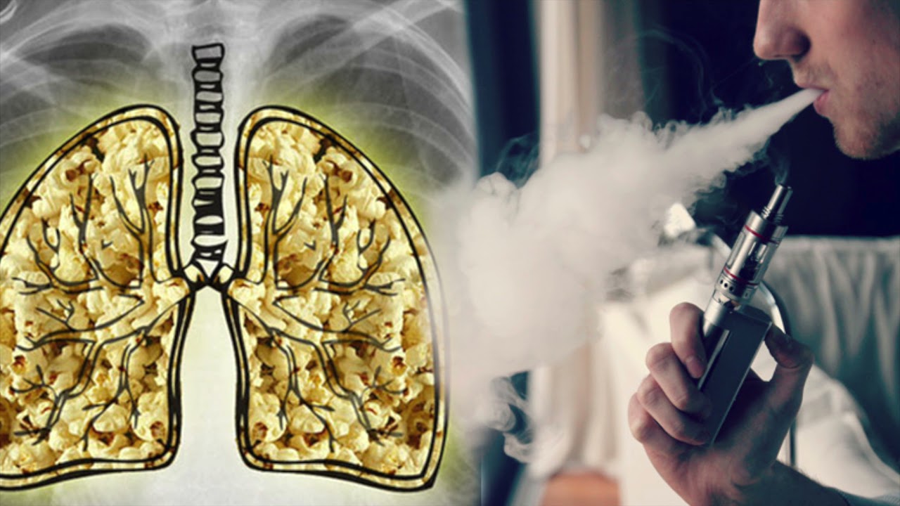 Легкие Вейпера Фото Рентген — Картинки фотографии