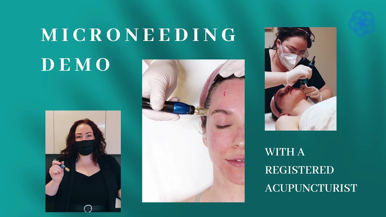 Microneedling Demo With A Registered Acupuncturist!