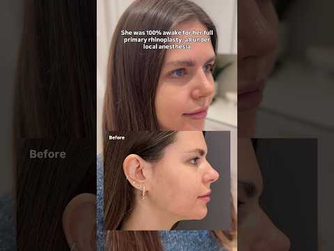 Video thumbnail: Not typical at ALL… #rhinoplasty · Albert Plastic Surgery New York